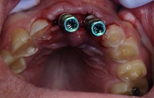ایمپلنت دندان پاسداران